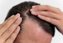 hair-transplants-vs.-scalp-micropigmentation-for-men