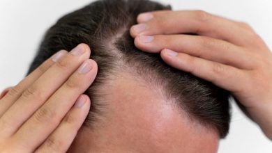 hair-transplants-vs.-scalp-micropigmentation-for-men